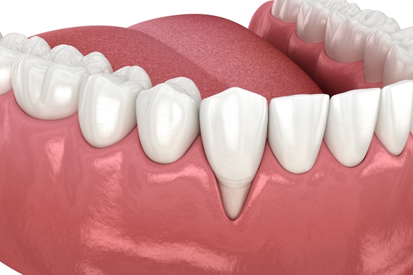 Your Gums Are Receding