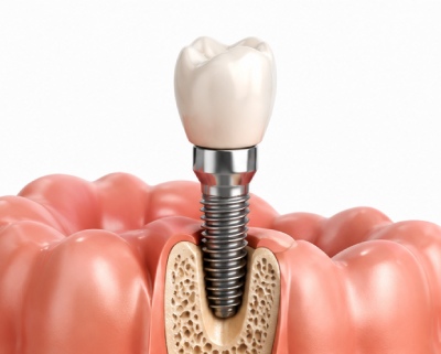 Single Tooth Dental Implant