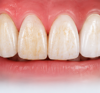 Professional Laser Teeth Whitening in Hamden CT
